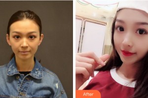 三亞維多利亞醫(yī)療美容醫(yī)院杜經緯整形價格表附自體脂肪填充案例展示