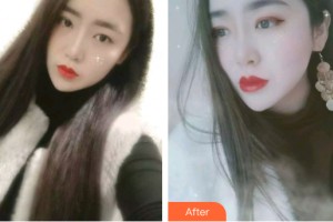 三亞韓氏醫(yī)療美容門診部張慧整形價格表附牙齒矯正案例展示