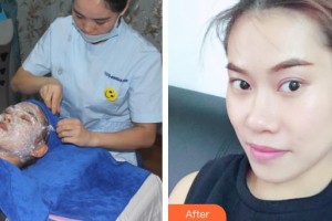 運城海鷗美容外科診所程東海整形價格表附微針水光案例展示