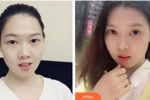 運城薛大夫整形美容門診部刑新整形價格表附定點雙眼皮案例展示