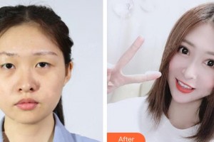 九江瑞麗醫(yī)療美容醫(yī)院殷運城整形價格表附眼部綜合案例展示