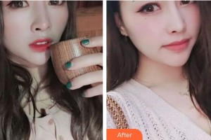 運城光子醫(yī)療美容門診部羅金剛整形價格表附眼部綜合案例展示