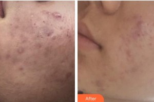 運(yùn)城臻美整形美容醫(yī)院郝瑞鵬整形價(jià)格表附微針美膚案例展示