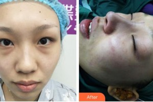 運(yùn)城華美醫(yī)學(xué)美容醫(yī)院王惠民整形價(jià)格表附清潔祛痘案例展示