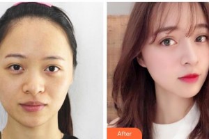 運(yùn)城市皮膚病醫(yī)院醫(yī)學(xué)美容科邢俊蘭整形價(jià)格表附激光祛斑案例展示