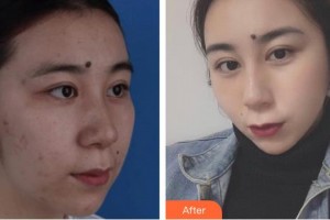 運(yùn)城華美醫(yī)學(xué)美容醫(yī)院陳先才整形價(jià)格表附鐳射凈膚案例展示