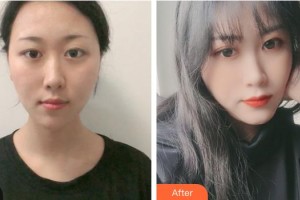 運(yùn)城光子醫(yī)療美容門診部郝睿鵬整形價(jià)格表附激光祛斑案例展示