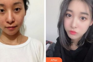 運城愛爾眼科醫(yī)院劉斌虎整形價格表附開內(nèi)眼角案例展示