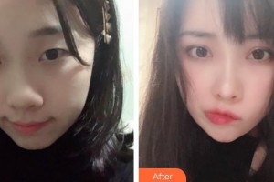 運(yùn)城愛爾眼科醫(yī)院莊立整形價(jià)格表附切開雙眼皮案例展示