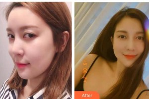 運(yùn)城愛爾眼科醫(yī)院魏潤梅整形價(jià)格表附眼部修復(fù)案例展示