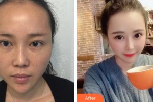 運(yùn)城愛爾眼科醫(yī)院賈保平整形價(jià)格表附眼部修復(fù)案例展示