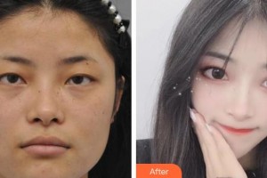 運(yùn)城愛爾眼科醫(yī)院高巖整形價(jià)格表附眼部綜合案例展示