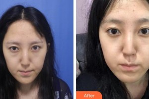 運(yùn)城市皮膚病醫(yī)院醫(yī)學(xué)美容科任璐璐整形價(jià)格表附激光去眼袋案例展示