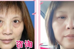 運城市眼科醫(yī)院潘秀紅整形價格表附激光去眼袋案例展示