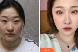 運(yùn)城市眼科醫(yī)院張建民整形價(jià)格表附眼部綜合案例展示