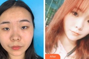 運城市眼科醫(yī)院付明山整形價格表附定點雙眼皮案例展示