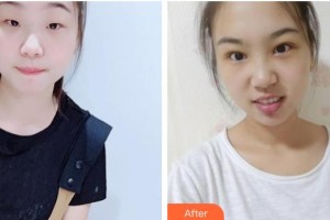 運城愛爾眼科醫(yī)院賈穎麟整形價格表附切開雙眼皮案例展示