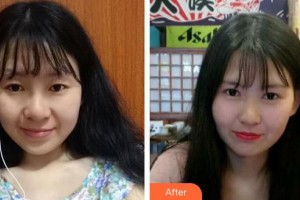 運城市眼科醫(yī)院趙斌整形價格表附切開雙眼皮案例展示