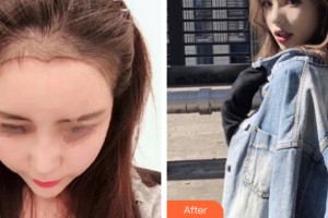 西寧夏都醫(yī)療美容醫(yī)院雷克整形價(jià)格表附植發(fā)案例展示