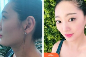 臨汾佳美醫(yī)療整形醫(yī)院候建軍整形價(jià)格表附硅膠隆鼻案例展示