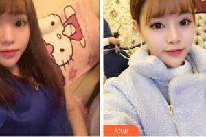 臨汾憶佳星醫(yī)療美容門診部曹玉靜整形價(jià)格表附鼻部綜合案例展示