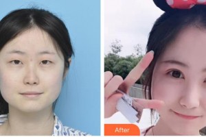 臨汾市堯都區(qū)眼科醫(yī)院張愛(ài)當(dāng)整形價(jià)格表附切開雙眼皮案例展示