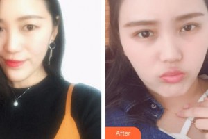 臨汾市堯都區(qū)眼科醫(yī)院梁慧琴整形價(jià)格表附眼部綜合案例展示