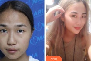 臨汾市堯都區(qū)眼科醫(yī)院馮珍整形價(jià)格表附切開雙眼皮案例展示