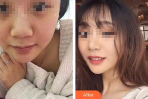 臨汾堯都恒信齒科診所范亞偉整形價(jià)格表附隱形托槽矯正案例展示