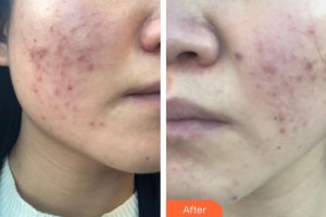 臨汾麗都整形美容門診部姚天飛整形價(jià)格表附微針美膚案例展示