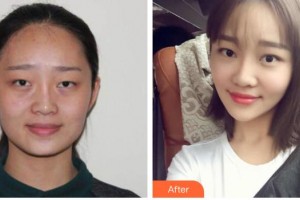 內蒙古榮軍醫(yī)院整形美容科張啟凌整形價格表附光子嫩膚案例展示