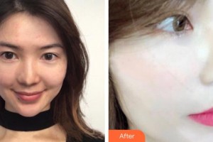 內(nèi)蒙古醫(yī)科大學(xué)附屬醫(yī)院整形美容燒傷科姜葵福整形價格表附光子嫩膚案例展示