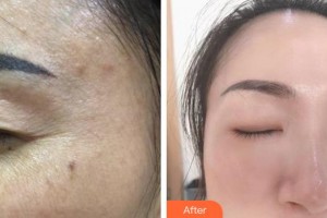 內(nèi)蒙古慕顏醫(yī)療美容門診部賈慧敏整形價格表附激光祛斑案例展示