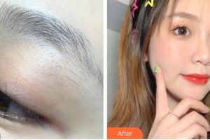 南昌愛思特醫(yī)療美容醫(yī)院涂勤勤整形價(jià)格表附紋眉案例展示