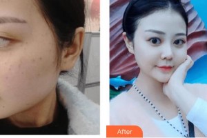 呼和浩特閆小林醫(yī)療美容門診部閆小林整形價格表附激光祛斑案例展示