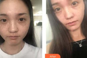 呼和浩特京華醫(yī)療美容診所溫麗霞整形價格表附激光祛斑案例展示