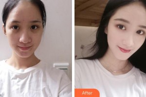 呼和浩特伊思整形?？漆t(yī)院白莉整形價格表附紅藍光祛痘案例展示