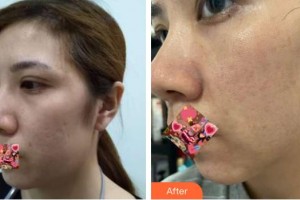 呼和浩特任榮大韓醫(yī)療美容診所劉洋整形價格表附白瓷娃娃案例展示