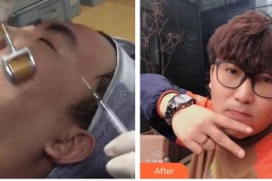 呼和浩特新視界眼科醫(yī)院賴靜整形價格表附去痘印痘坑案例展示