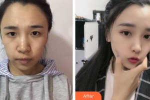 呼和浩特新視界眼科醫(yī)院代永青整形價(jià)格表附眼部綜合案例展示