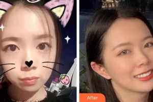 呼和浩特董志新口腔門診部金霞整形價(jià)格表附金屬托槽矯正案例展示