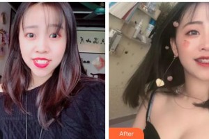 呼和浩特董志新口腔門診部董志新整形價(jià)格表附金屬托槽矯正案例展示