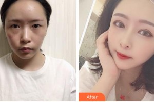 呼和浩特朝聚眼科醫(yī)院崔巍整形價(jià)格表附激光去眼袋案例展示