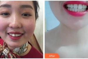 呼和浩特董志新口腔門診部董秀蘭整形價(jià)格表附牙齒隱形矯正案例展示