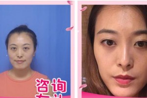 呼和浩特朝聚眼科醫(yī)院韓晶巖整形價(jià)格表附激光去眼袋案例展示