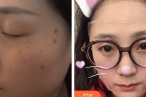 包頭葉子整形美容醫(yī)院馮守運(yùn)整形價(jià)格表附激光祛斑例展示