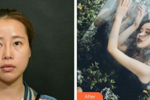 包頭李德皮膚醫(yī)院李德整形價(jià)格表附鼻翼縮小案例展示