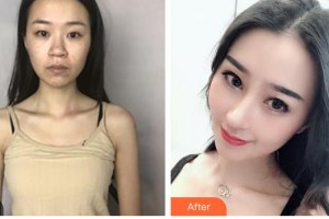 包頭李德皮膚醫(yī)院于習軍整形價格表附鼻部綜合案例展示