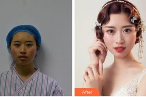 包頭時(shí)光醫(yī)療美容門診部常青整形價(jià)格表附埋線提升例展示