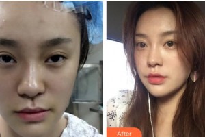 包頭聯(lián)合麗格醫(yī)療美容門診部董曉宏整形價(jià)格表附埋線提升案例展示